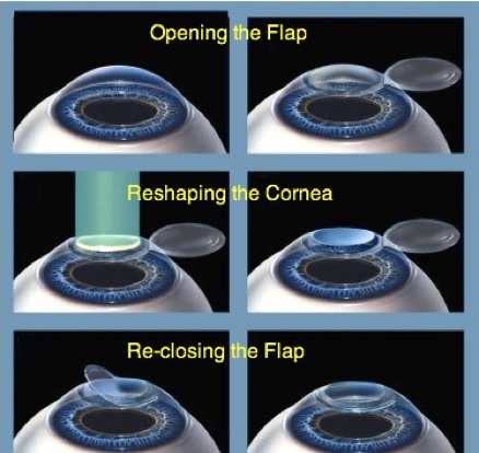 laser refractive surgery